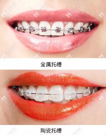 固定和隱形矯治器優(yōu)缺點大pk,矯治時間和結(jié)束效果一樣嗎?