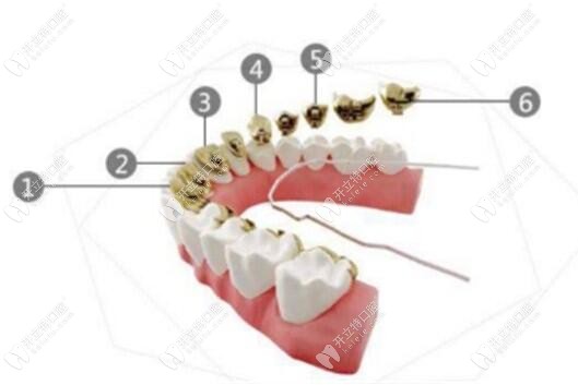 進(jìn)口3m黃金incognito舌側(cè)隱形矯正費(fèi)用