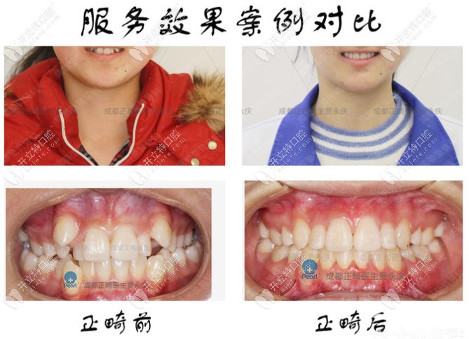 成都圣貝口腔正畸案例