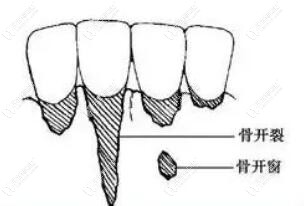 好怕怕,矯正骨開(kāi)窗開(kāi)裂的人多嗎?什么情況下容易骨開(kāi)窗開(kāi)裂