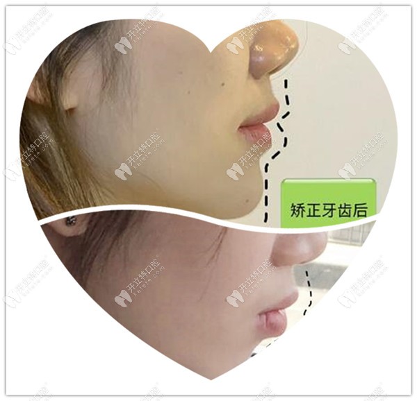 齙牙凸嘴牙齒矯正前后對比