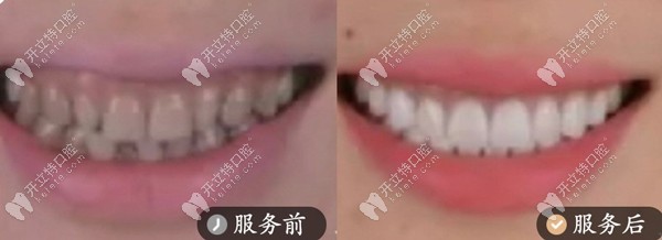 正畸案例-金屬托槽矯正器