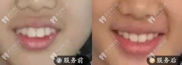 正畸案例-青少年矯正案例