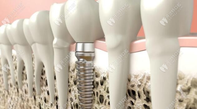 動真格：這即刻負重種植技術(shù)，真能實現(xiàn)當(dāng)天種牙當(dāng)天吃！