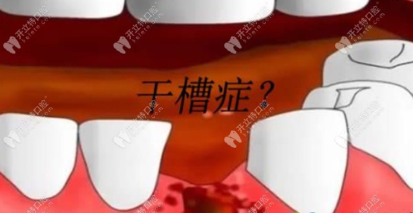 專治不明白：拔牙后血凝塊掉了一定會得干槽癥嗎~幾率多大