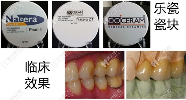 德國杜塞拉姆全瓷牙臨床效果