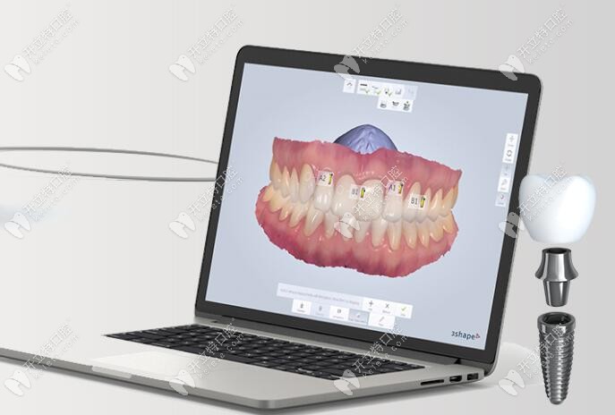 數(shù)字導板導航種植牙