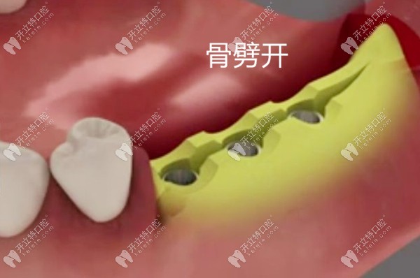 骨劈開術過程演示