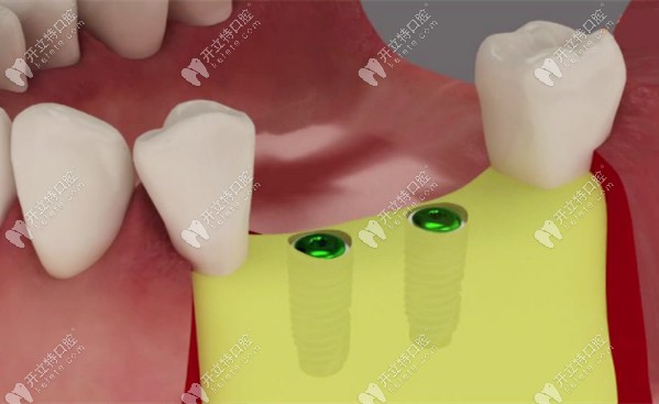 什么是骨擠壓技術