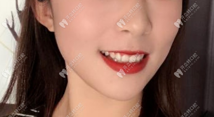 摘了牙套后牙齒整體效果 摘了牙套后牙齒整體效果