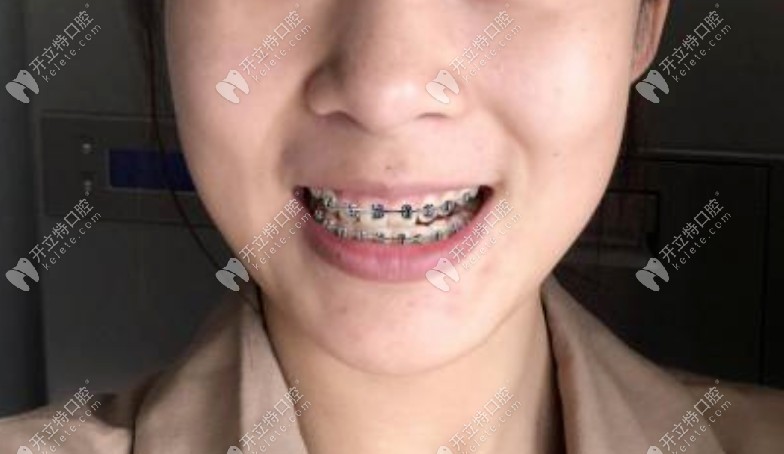 矯正剛帶上牙套一周的時間 矯正剛帶上牙套一周的時間