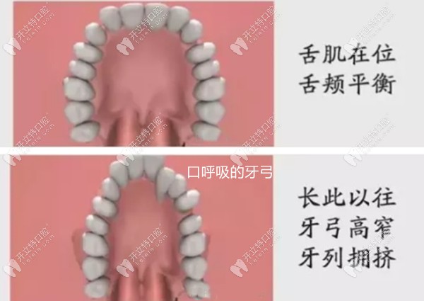 正常牙弓和長期口呼吸牙弓對比