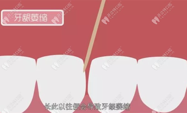 牙簽會(huì)導(dǎo)致牙齦萎縮
