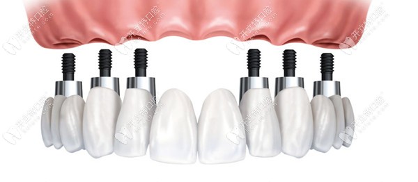 傳統(tǒng)的種植牙技術(shù)時(shí)間比較長(zhǎng)