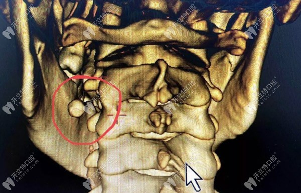 罕見的涎石癥也會引起口腔下頜腫脹、疼痛