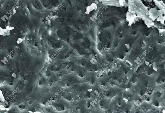 沒(méi)有沖洗過(guò)的根管鈣化外觀