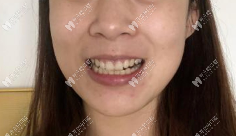 咬合不正導致嘴歪嚇得我麻溜去做了奧美科金屬托槽矯正