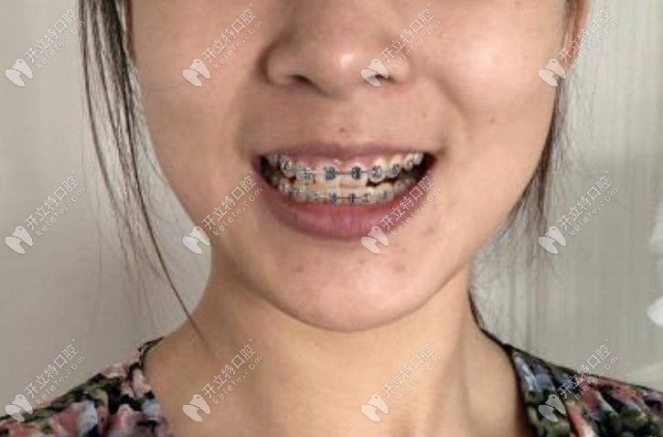 矯正后期快摘牙套了 矯正后期快摘牙套了