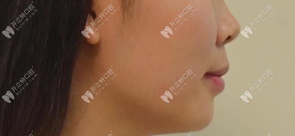 完成矯正后的側(cè)面變化 完成矯正后的側(cè)面變化