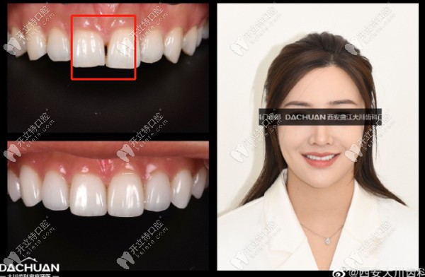  閨蜜出嫁前做了義獲嘉超薄全瓷美白牙貼面，這效果我i了