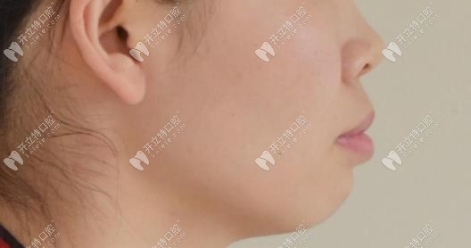 矯正前我的側(cè)面情況 矯正前我的側(cè)面情況