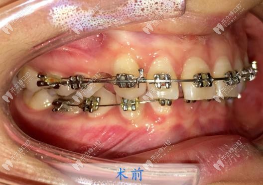 剛戴上牙套牙齒的樣子 剛戴上牙套牙齒的樣子
