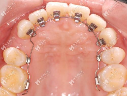 舌側(cè)矯正在口內(nèi)的示意圖