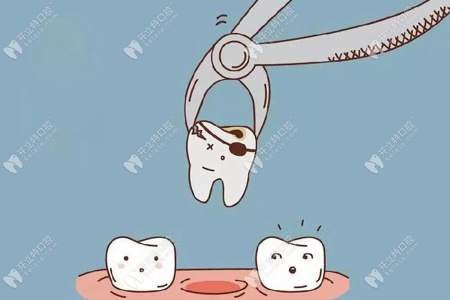 矯正拔除了一顆牙齒 矯正拔除了一顆牙齒