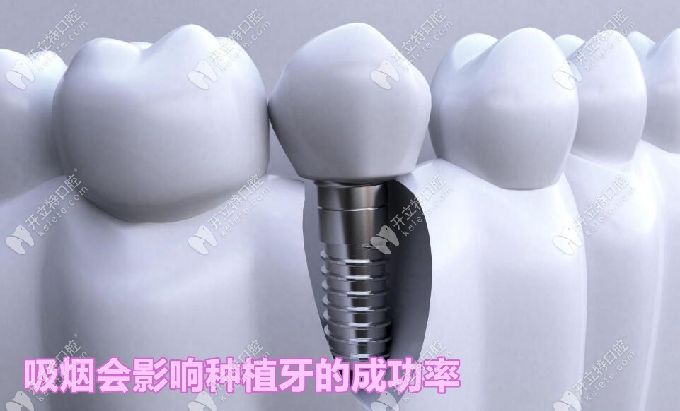 種植牙后期盡量要控制吸煙次數(shù)