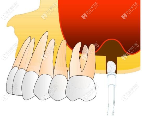 改良式微創(chuàng)上頜竇提升術(shù)