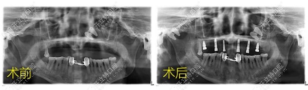 案例|半口6顆植體做即刻種植牙只要2小時,且當(dāng)天戴冠吃東西