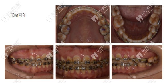 維樂口腔做金屬固定矯正兩年時(shí)間結(jié)束