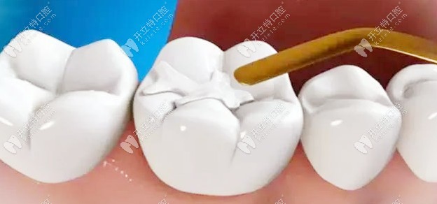 又問美國進(jìn)口3M樹脂補(bǔ)牙的價(jià)格？z350與250多少錢都在這了！