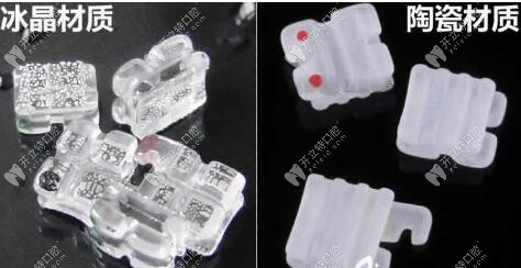 價格相差幾千的單晶托槽和陶瓷半隱形矯正到底有啥區(qū)別