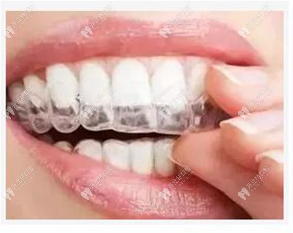 隱形牙套相對(duì)于金屬牙套美觀度比較高