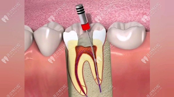 漲知識啦,原來根管超聲蕩洗的流程和作用是這樣滴