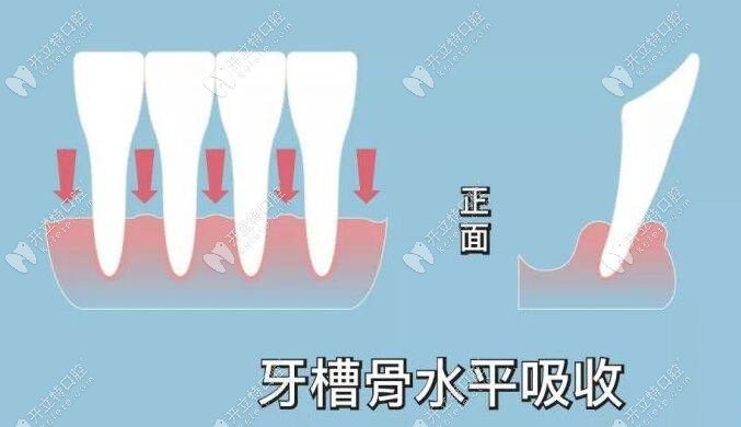 牙槽骨吸收癥狀