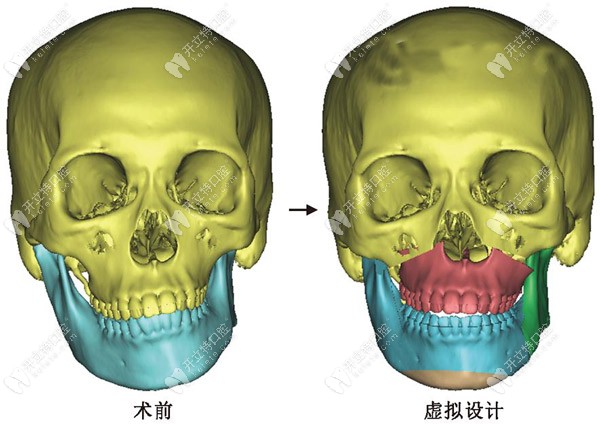 上海哪個(gè)醫(yī)院做正頜手術(shù)好,選個(gè)厲害的頜面外科醫(yī)生很關(guān)鍵