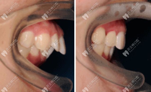 牙齒向前突出的嘴凸