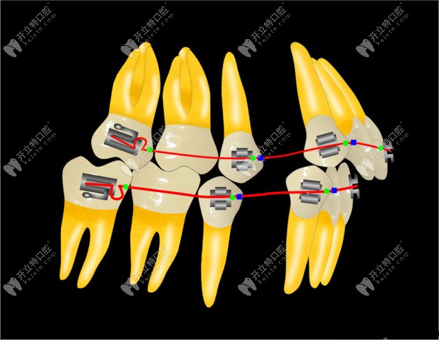 針對于重度錯頜畸形的Tweed-Merrfield定向力矯正技術(shù)有何特點