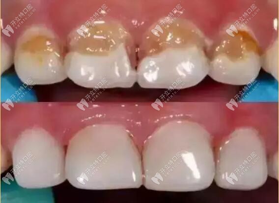 透明預(yù)成冠