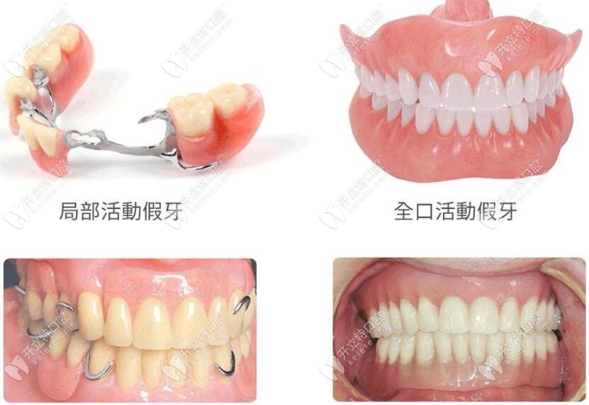局部假牙和全口假牙