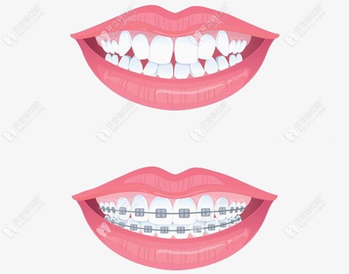牙齒矯正前后對比 牙齒矯正前后對比