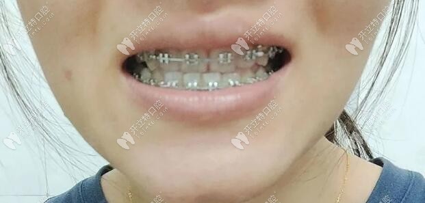 中線不齊，下牙排列不齊，以上問題下月調(diào)整