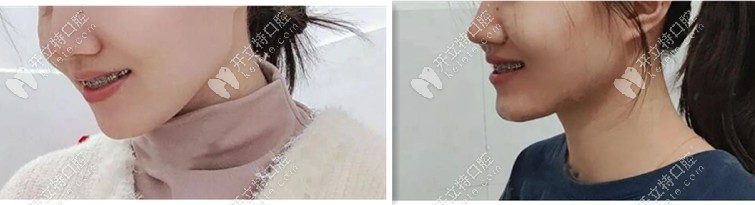 一年半后矯正效果——側(cè)顏好點哦