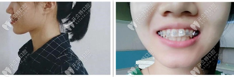 牙套兩個月側(cè)臉，嘴還是突
