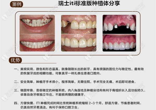 瑞士iti標(biāo)準(zhǔn)版種植牙案例