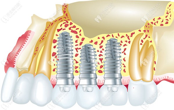 不同型號種植體在骨內(nèi)的<span style=