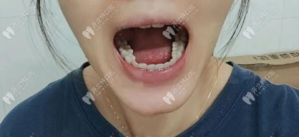 半年的時候，下排磨牙有些內(nèi)傾