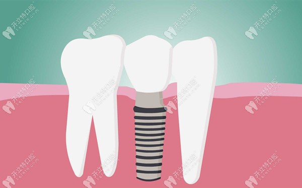 德國種植系統(tǒng)中的ICX和camlog對比